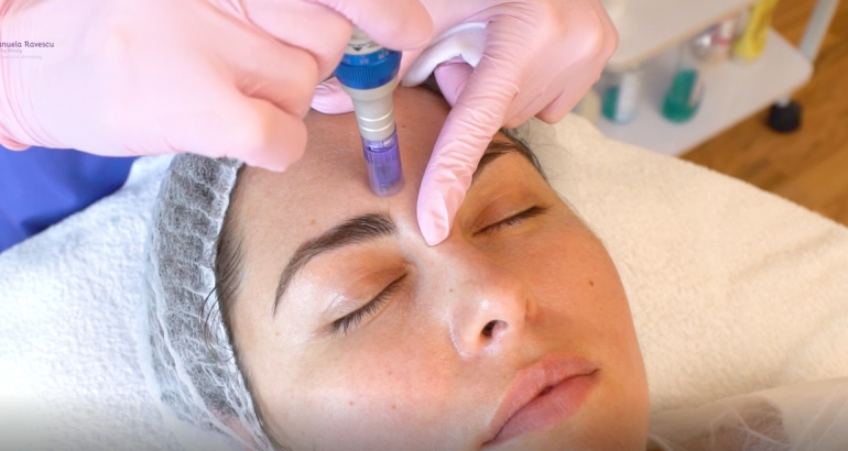 Microneedling