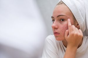 tratament rozacee la adolescenti